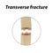 Transverse bone fracture. Infographics. Vector illustration on a lined background.