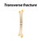 Transverse bone fracture. Infographics. Vector illustration on a lined background.