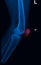 Trauma knee joint x-rays image