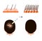 Treatment of alopecia. Bald spot, baldness, Alopecia mesotherapy. Infographics. Vector illustration on isolated