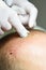 Treatment of baldness with beauty injections. Mesotherapy. Plasmalifting.