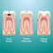 Treatment Of Caries. Dental Filling. Dental Caries Detailed Isolated On A Background. Vector Illustration.