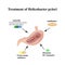 Treatment of Helicobacter pylori. Medications. Antacids, proton pump blockers and H2-histamine blockers. Infographics