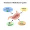 Treatment of Helicobacter pylori. Medications. Antacids, proton pump blockers and H2-histamine blockers. Infographics