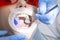 Treatment of tooth decay. girl at  reception at the dentist. the doctor drilled a tooth boron machine removed caries. the tooth is