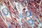 Trichinic parasites in muscle tissue