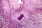Tubercle, light micrograph