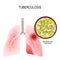 Tuberculosis is an infection caused by bacteria. Lungs of infect