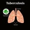 Tuberculosis. Lung disease. Tubercle bacillus. Vector illustration on a black background