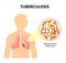 Tuberculosis, MTB or TB