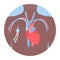 Tunneled central line venous catheter medical diagram