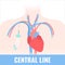 Tunneled central line venous catheter medical diagram