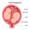 Twin pregnancy. Anatomy of womb with twin fetuses. Dizygotic