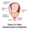 Twin-to-twin transfusion syndrome, feto-fetal transfusion syndrome. disproportionate blood supply. Two fetuses in womb, one bigger