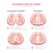 Twin types infographic elements in flat design. Monozygotic or Dizygotic Placentation of twins medical illustration and