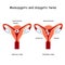 Twins in uterus. Monozygotic and Dizygotic