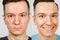Two guys before-after: left guy with acne, red spots, problem skin, right guy with healthy skin. Acne treatment concept