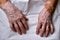 Two hands of an old woman damaged by vitiligo disease.