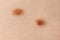 Two Mole birthmark nevus macro photo on human skin. Close up.