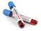 Two tube with blood samples for Coronavirus test COVID-19 - virus protection concept