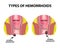 Two types of hemorrhoids are external and internal. Rectum structure. Intestines. colon. Internal and external hemorrhoidal node.