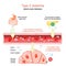 Type 2 diabetes. adult-onset diabetes