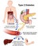 Type 2 diabetes medical  illustration with english description