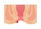 Type of Hemorrhoid flat vector illustration / External hemorrhoid