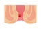 Type of Hemorrhoid flat vector illustration / Internal hemorrhoid