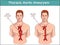 Types of abdominal aortic aneurysm. normal aorta and enlarged vessels. Vector diagram