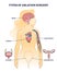 Types of ablation surgery with brain and cardiac example outline diagram