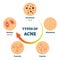 Types of acne as medical skin disease comparison scheme vector illustration
