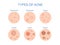 Types of Acne  icon for skin problems content.