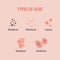 Types of acne illustration vector on white background, Beauty co