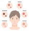 Types of acne and man face illustration. whitehead,black head, papules, and pustules. men`s beauty skin care concept