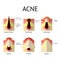 Types of acne pimples. Healthy skin, Whiteheads and Blackheads, Papules and Pustules in flat style.