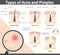 Types of Acne and Pimples, vector illustration