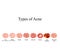 Types of Acne Skin inflammation. Pimples, boils, whitehead, closed comedones, papules, pustules, cystic acne
