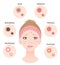 Types of acne and woman face illustration. whitehead,black head, papules, and pustules. Beauty skin care concept