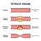 Types of angina as chest pain and heart problem explanation outline diagram