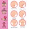 Types of appearances of the breast