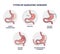 Types of bariatric surgery and stomach reduction control outline diagram