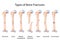 Types of bone fractures