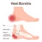 Types of bursitis. Shoulder, hip, heel, knee and elbow joints inflammation.