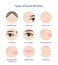 Types of facial wrinkles vector icon set illustration isolated on white background.