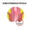 Types of fistulas of the rectum. Paraproctitis.