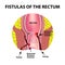 Types of fistulas of the rectum. Paraproctitis. Anus. Abscess of the rectum. Infographics. Vector illustration