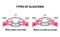 Types of glaucoma. Open-angle and angle-closure glaucoma. The anatomical structure of the eye. Infographics. Vector