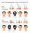 Types of hair transplantation FUE and FUT