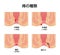 Types of Hemorrhoid flat vector illustration  Japanese